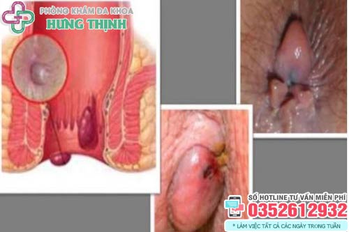 Bệnh trĩ ngoại chữa như thế nào