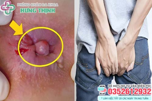 Bệnh trĩ ngoại có nguy hiểm không