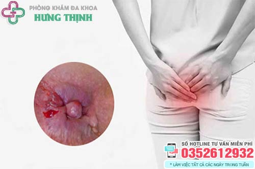 Bệnh trĩ ngoại là gì