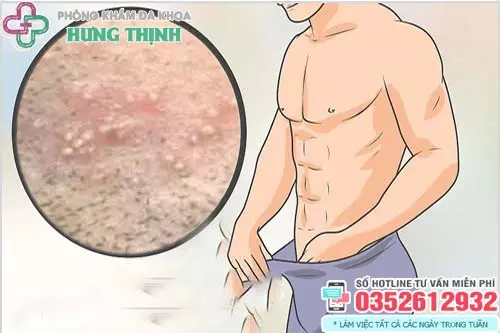Bị nấm ở vùng kín nam giới
