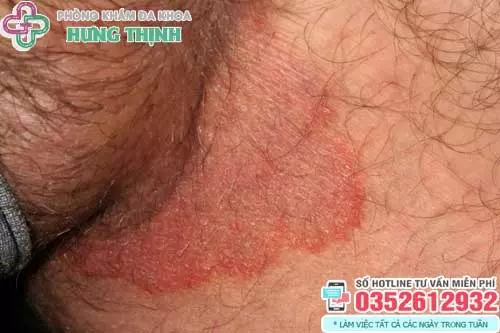 Cách trị bị nấm ở vùng kín nam giới