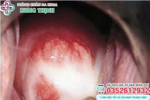 Cách trị nấm ở vùng kín nữ tại nhà