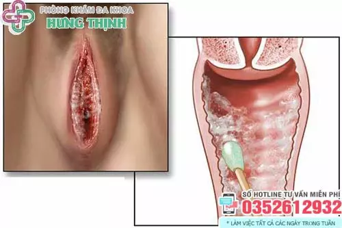 Candida hình ảnh bị nấm ở vùng kín