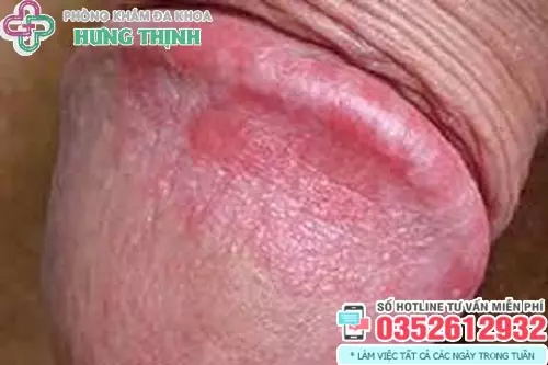 Đầu dương vật nổi mẩn đỏ có sao không?