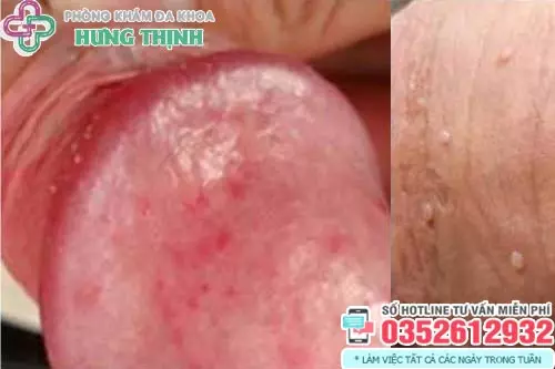 Đầu dương vật nổi mẩn đỏ là bệnh gì?