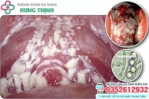 Dấu hiệu bị nấm ở vùng kín nam giới