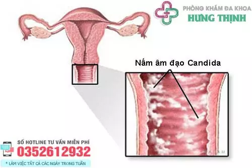 Dấu hiệu bị nấm ở vùng kín nữ