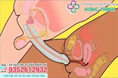 Dương vật dài bao nhiêu thì chạm cổ tử cung