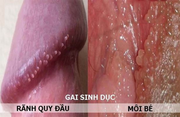 Hình ảnh gai sinh dục ở nam giới và nữ giới