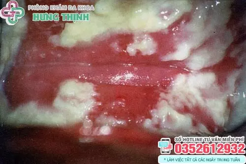 Hình ảnh bệnh nấm ở vùng kín
