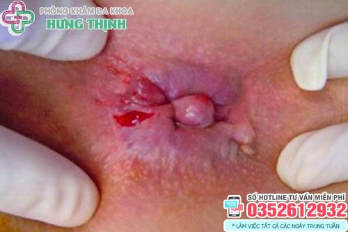 Hình ảnh bệnh trĩ ngoại độ 2