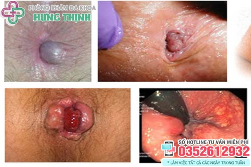 Hình ảnh bệnh trĩ ngoại độ 3
