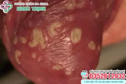 Hình ảnh bị nấm ở vùng kín nam giới