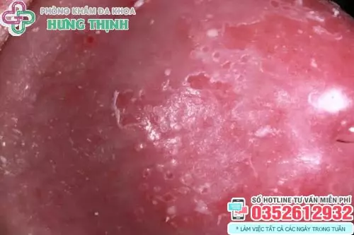 Hình ảnh bị nấm ở vùng kín nam giới