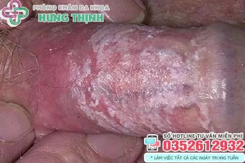 Hình ảnh bị nấm ở vùng kín nam giới
