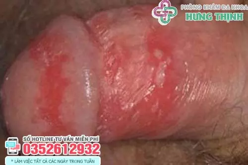 Hình ảnh bị nấm ở vùng kín nam