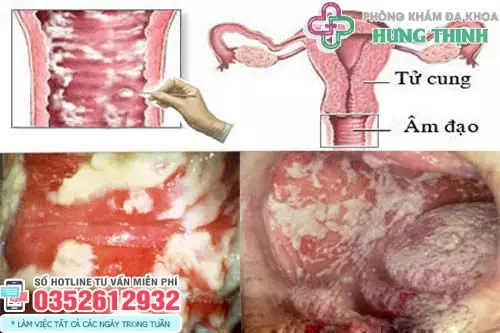 Hình ảnh bị nấm ở vùng kín nữ giới