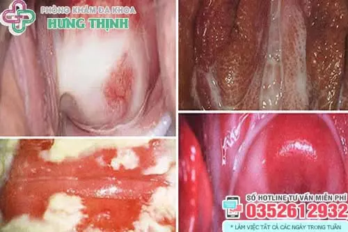 Hình ảnh nấm ngứa vùng kín