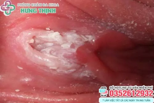 Hình ảnh nấm ở vùng kín