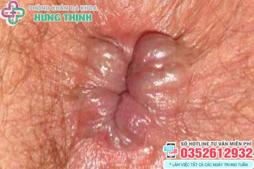 Hình ảnh trĩ ngoại cấp độ 1