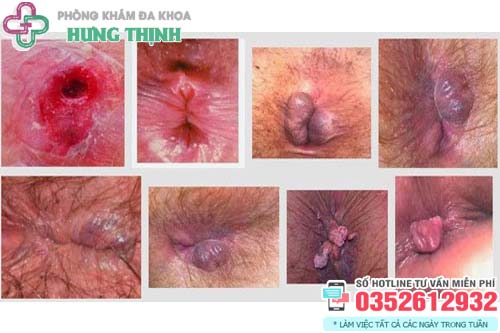 Hình ảnh trĩ ngoại độ 3