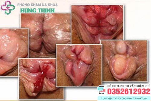 Hình ảnh trĩ ngoại độ 4 tắc mạch