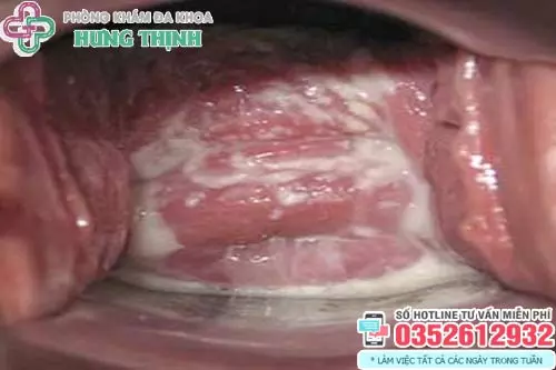 Hình ảnh vùng kín bị nấm Candida