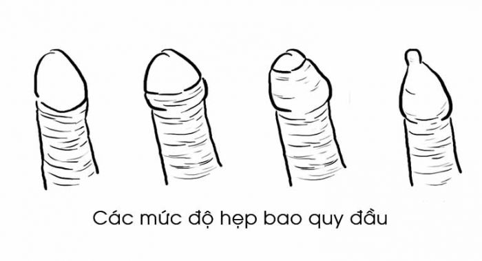 Mức độ hẹp bao quy đâu