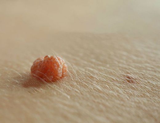 Phân biệt mụn cóc sinh dục và sùi mào gà
