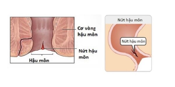 Dấu hiệu nứt kẽ hậu môn
