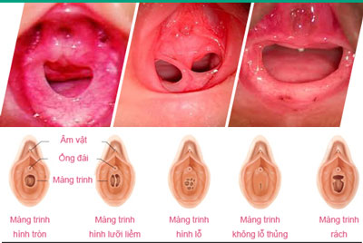 Vá màng trinh để làm gì