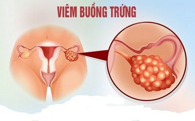 Viêm buồng trứng là gì