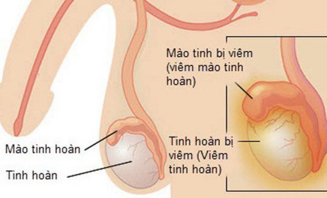 Viêm tinh hoàn là bệnh gì