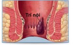 Trĩ nội: Dấu hiệu, cách chữa và phòng ngừa