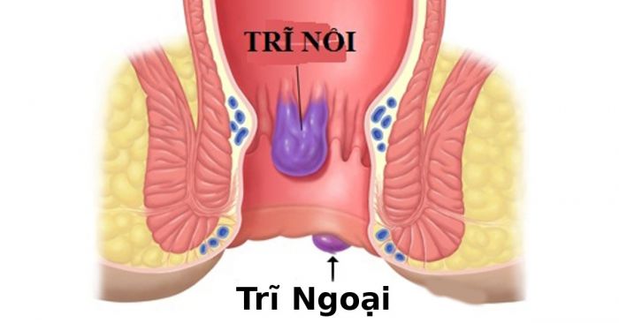 Bệnh trĩ ngoại: Nguyên nhân, dấu hiệu và cách điều trị