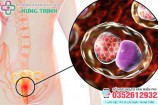 10+ Cách chữa bệnh lậu tại nhà đơn giản hiệu quả