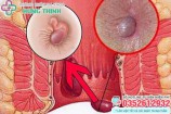 12 Cách chữa bệnh trĩ (nội, ngoại) tại nhà hiệu quả nhất