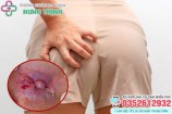 10 Cách làm co búi trĩ ngoại tại nhà làm teo xẹp búi trĩ nhanh nhất