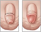 Chi phí cắt bao quy đầu ở Hà Nội bao nhiêu tiền? [Bảng giá]