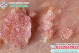 Chi phí chữa bệnh sùi mào gà hết bao nhiêu tiền