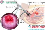 Chi phí đốt viêm lộ tuyến cổ tử cung giá bao nhiêu tiền 2026