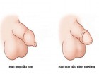 Top 7 địa chỉ cắt, chữa hẹp bao quy đầu ở đâu tốt tại Hà Nội