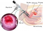 Đốt viêm lộ tuyến cổ tử cung bao nhiêu tiền?