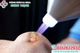 Đốt sùi mào gà: Những điều cần lưu ý khi thực hiện