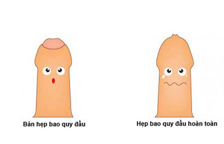 Hẹp bao quy đầu: Nguyên nhân, dấu hiệu, cách chữa trị