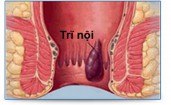 Trĩ nội: Dấu hiệu, cách chữa và phòng ngừa