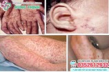 12 Địa chỉ xét nghiệm khám chữa bệnh giang mai ở đâu tốt Hà Nội