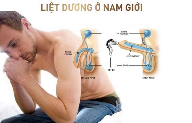 Liệt dương: Nguyên nhân, dấu hiệu và cách chữa trị