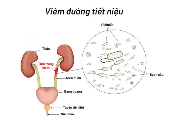 Viêm đường tiết niệu là gì? Dấu hiệu và cách điều trị