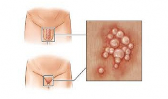 Herpes sinh dục: Triệu chứng, nguyên nhân và cách điều trị